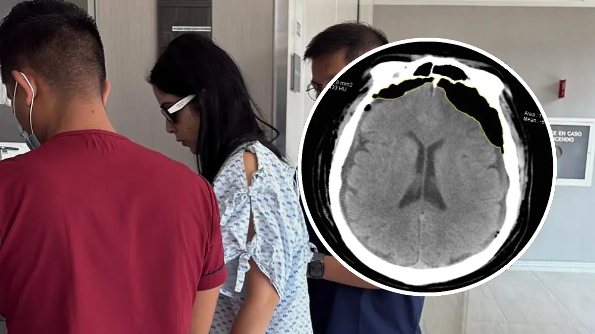 FULL SCREEN  LUPITA VILLALOBOS HEMATOMA SUBDURAL (1)