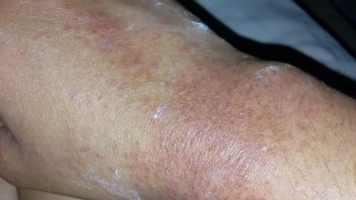 36 SERGIO En algunos casos gel ya causó alergias1