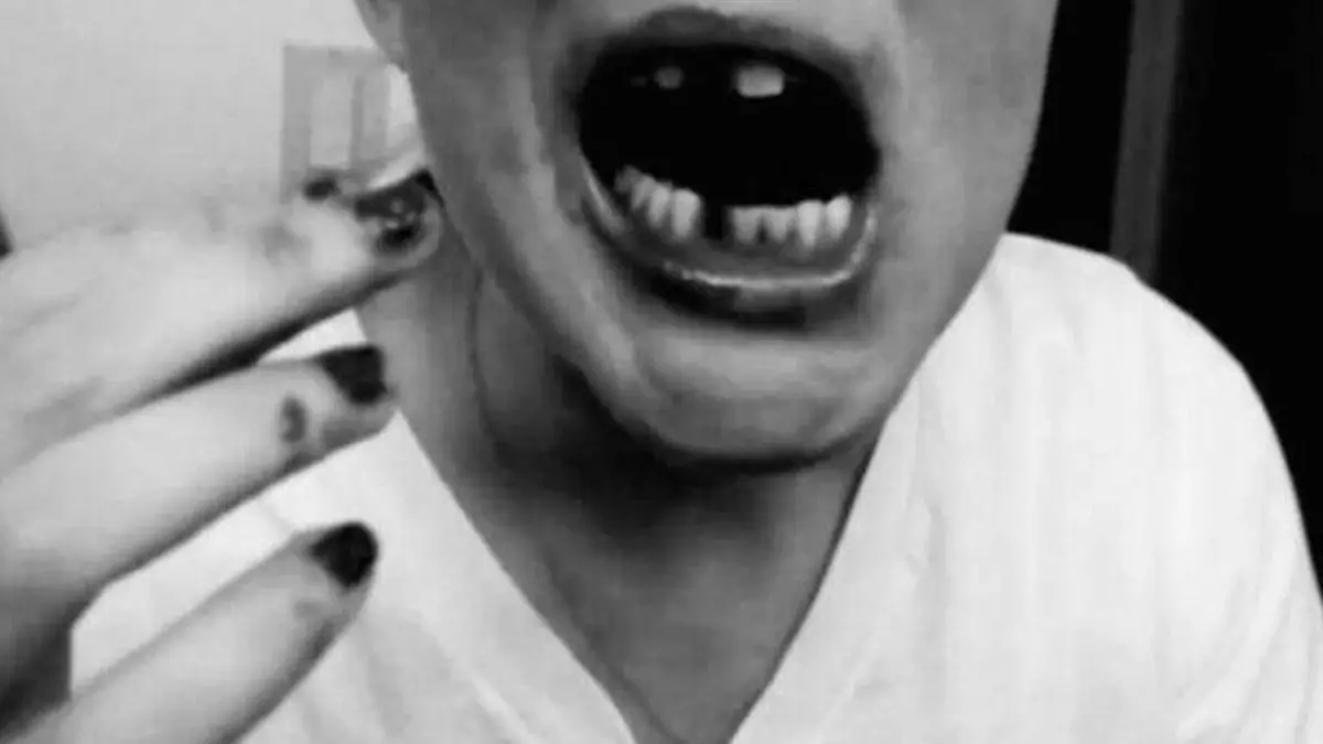 caida de dientes