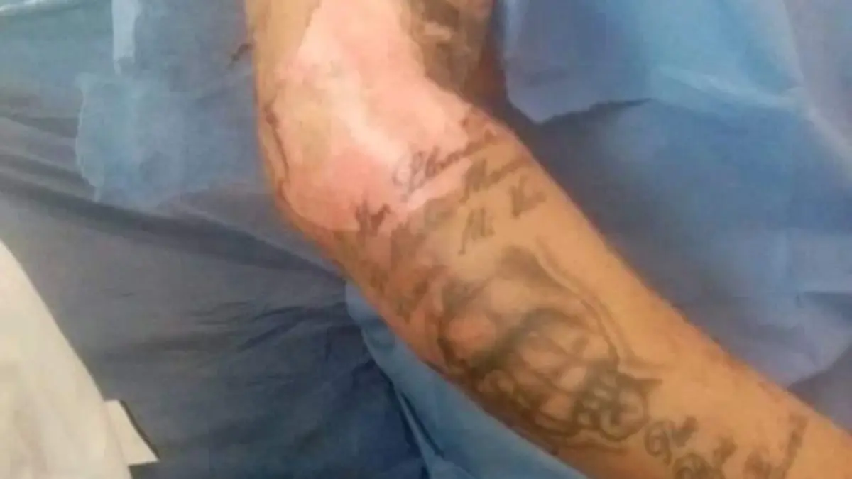 empleados quemaduras