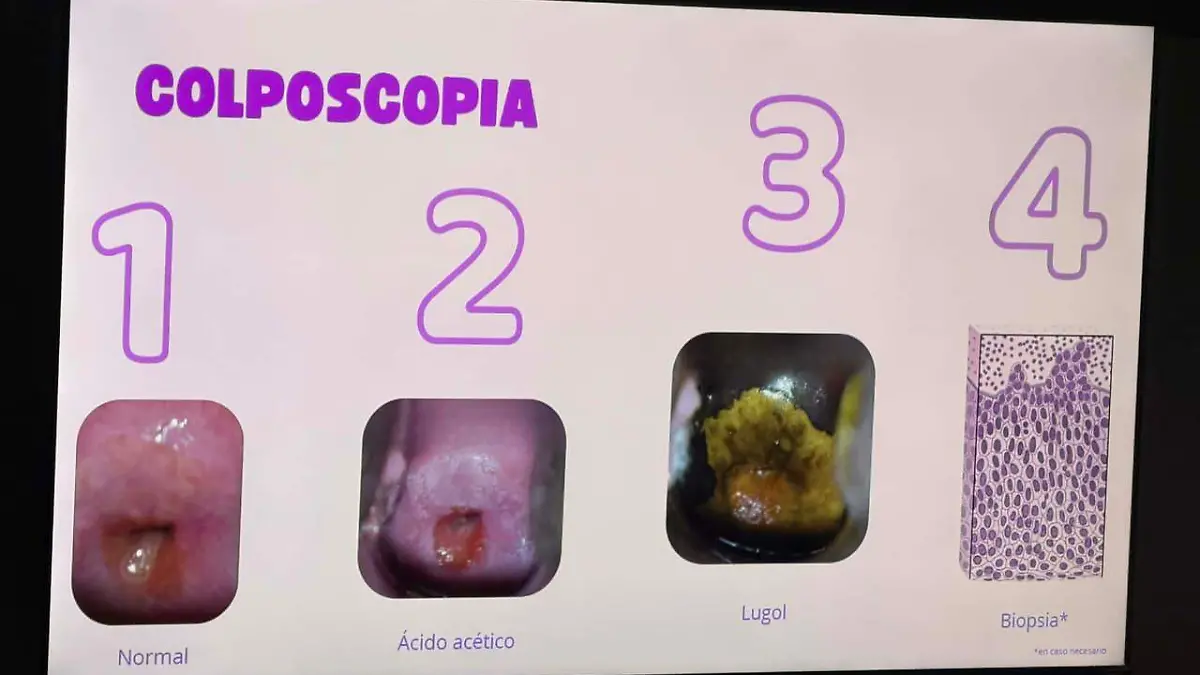 Así luce un cérvix infectado