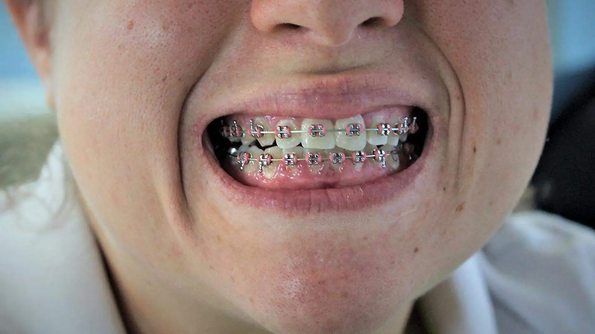 SaludDental-Brackets-Dientes-Sonrisa