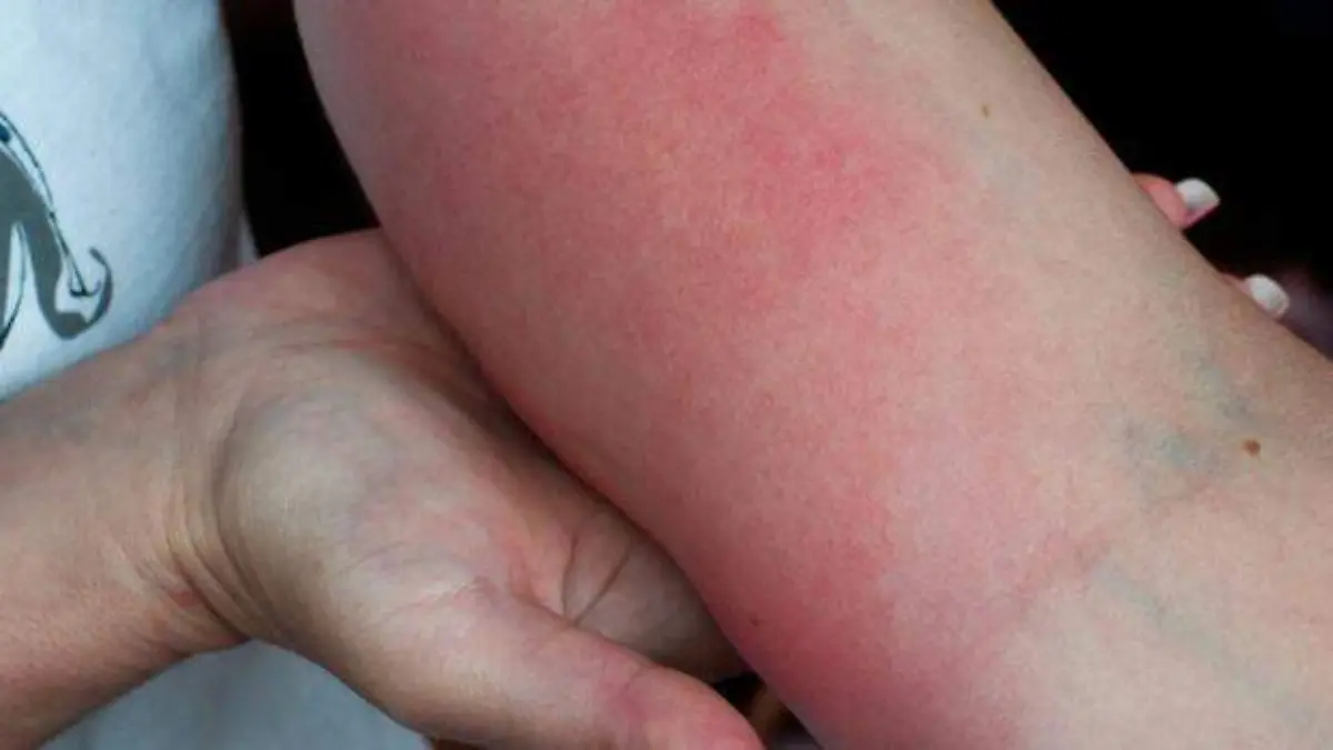 Ayuda-para-los-pacientes-de-Lyme