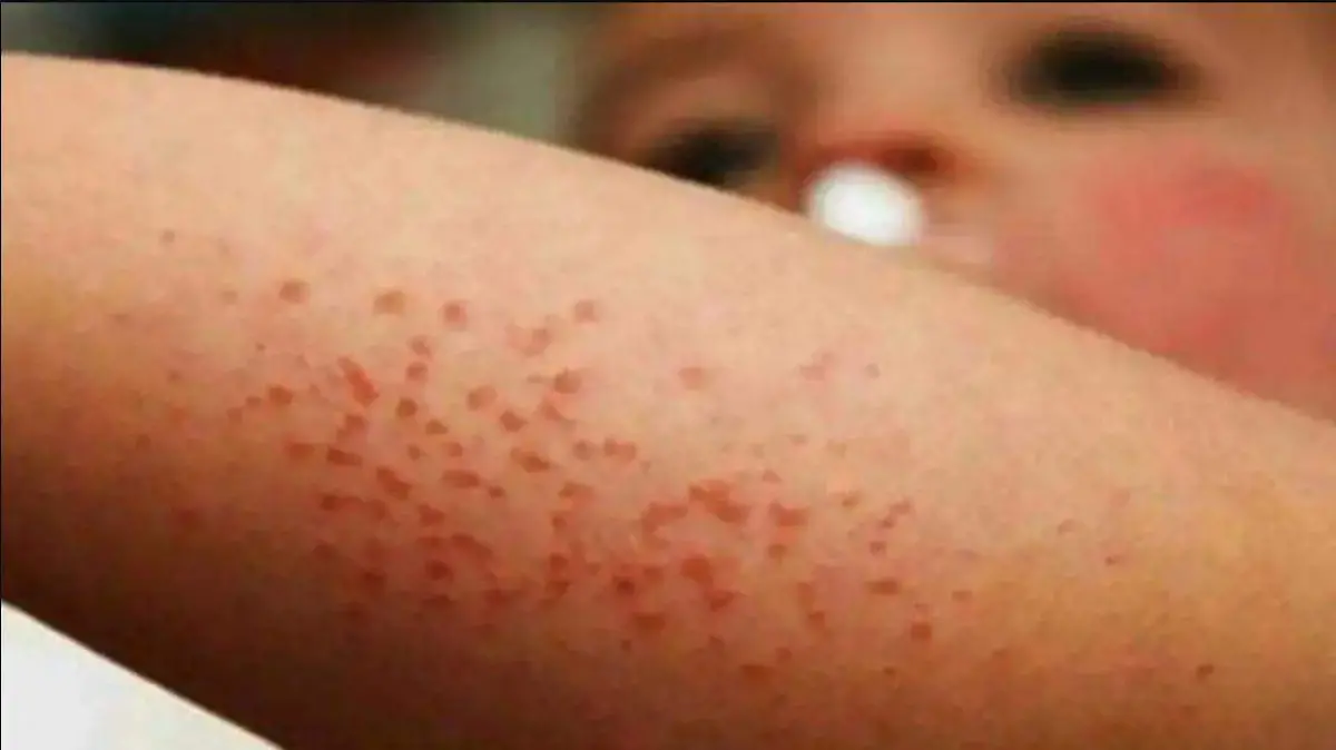 SINTOMAS, SARAMPIÓN 2