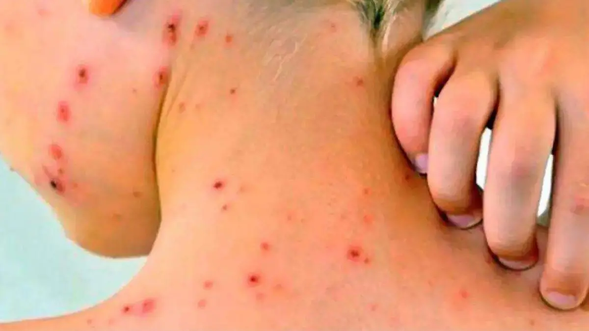 SARAMPIÓN-CONTACTO-SINTOMAS