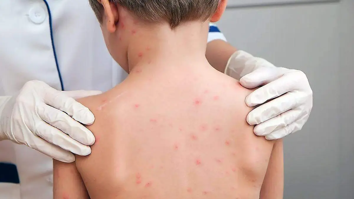  VACUNA_SARAMPIÓN_EPIDEMIA