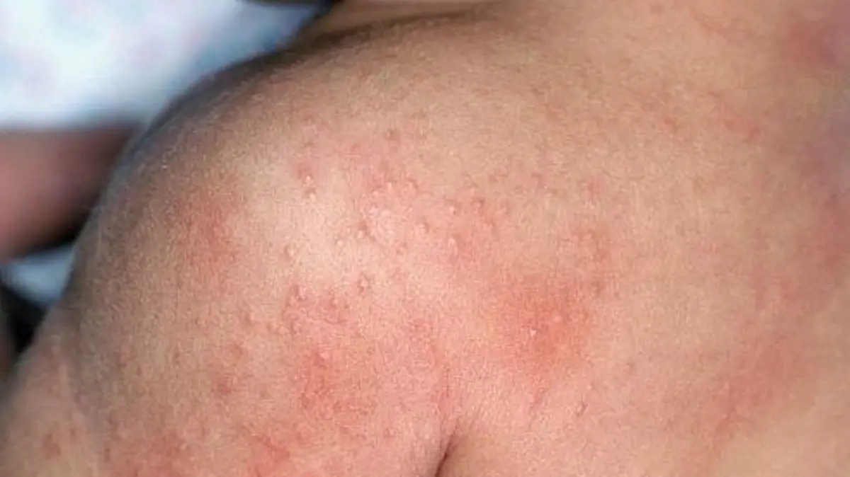 sarpullido2