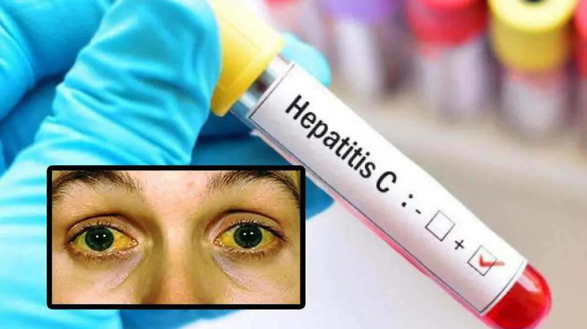 hepatitis (1)
