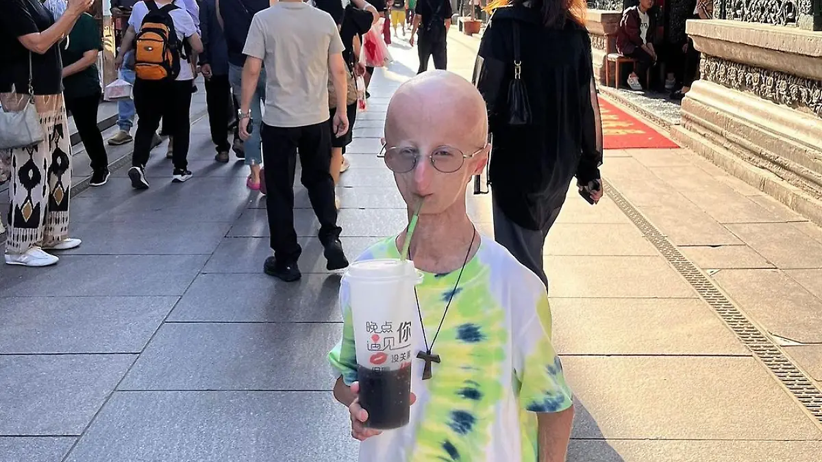 Sammy Basso-Progeria