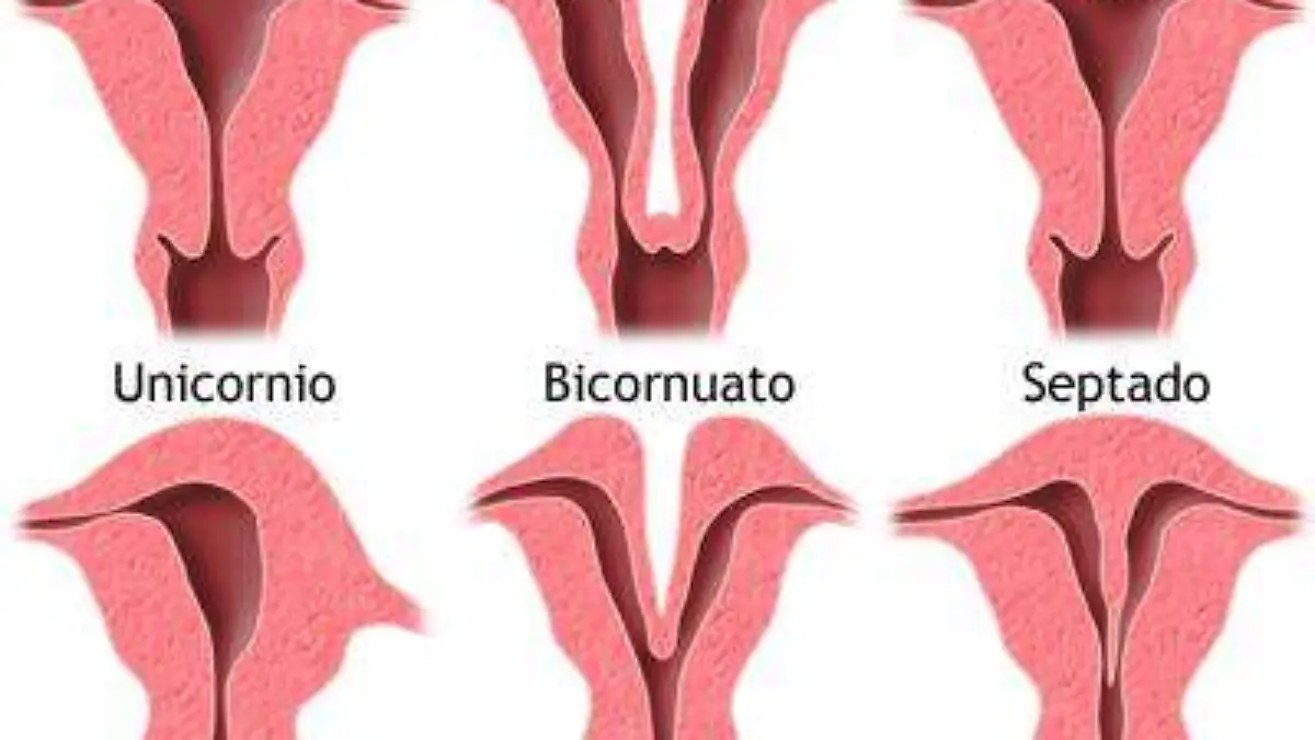 ¿Por qué el útero didelfo es una malformación congénita?