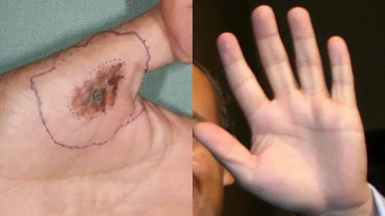 Cáncer de piel en manos