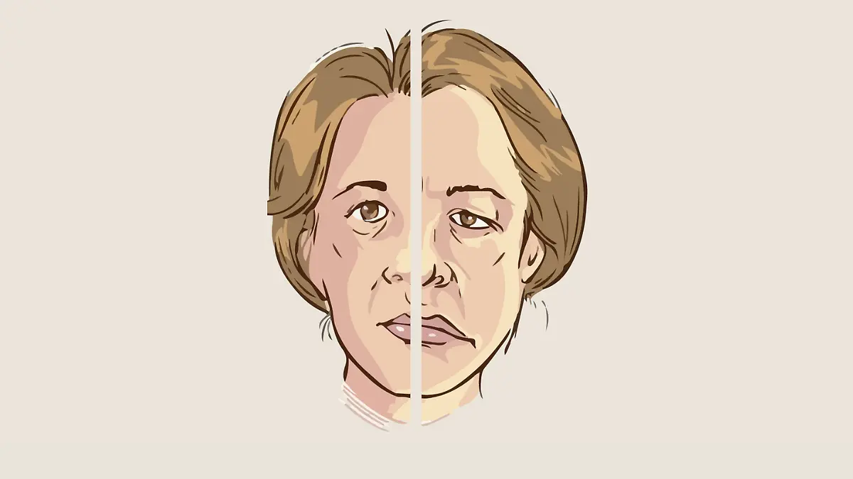 Parálisis facial