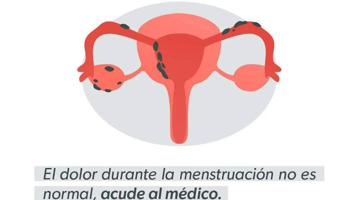 Endometriosis, salud, mujeres, dolor