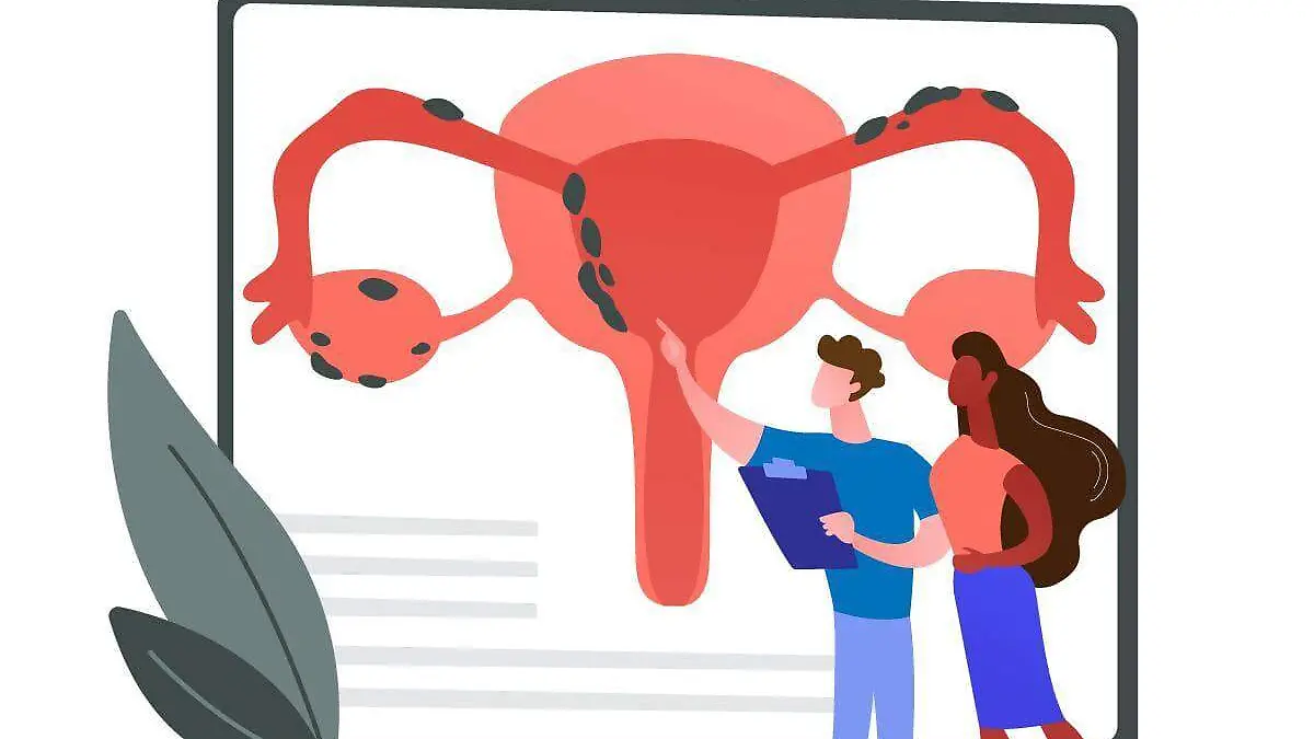 Endometriosis, salud, mujeres, dolor