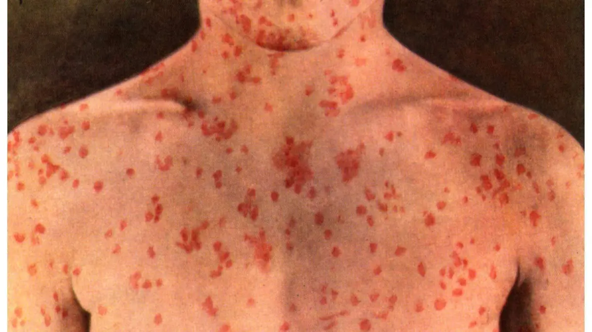 brote-de-sarampion_b0417