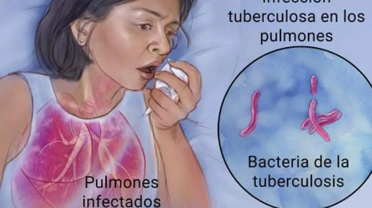 TUBERCULOSIS