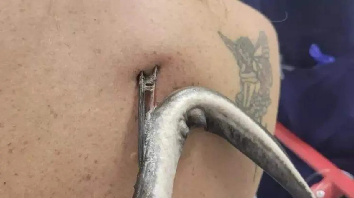 Mujer estuvo cerca de perder un pulmón tras ataque de mantarraya