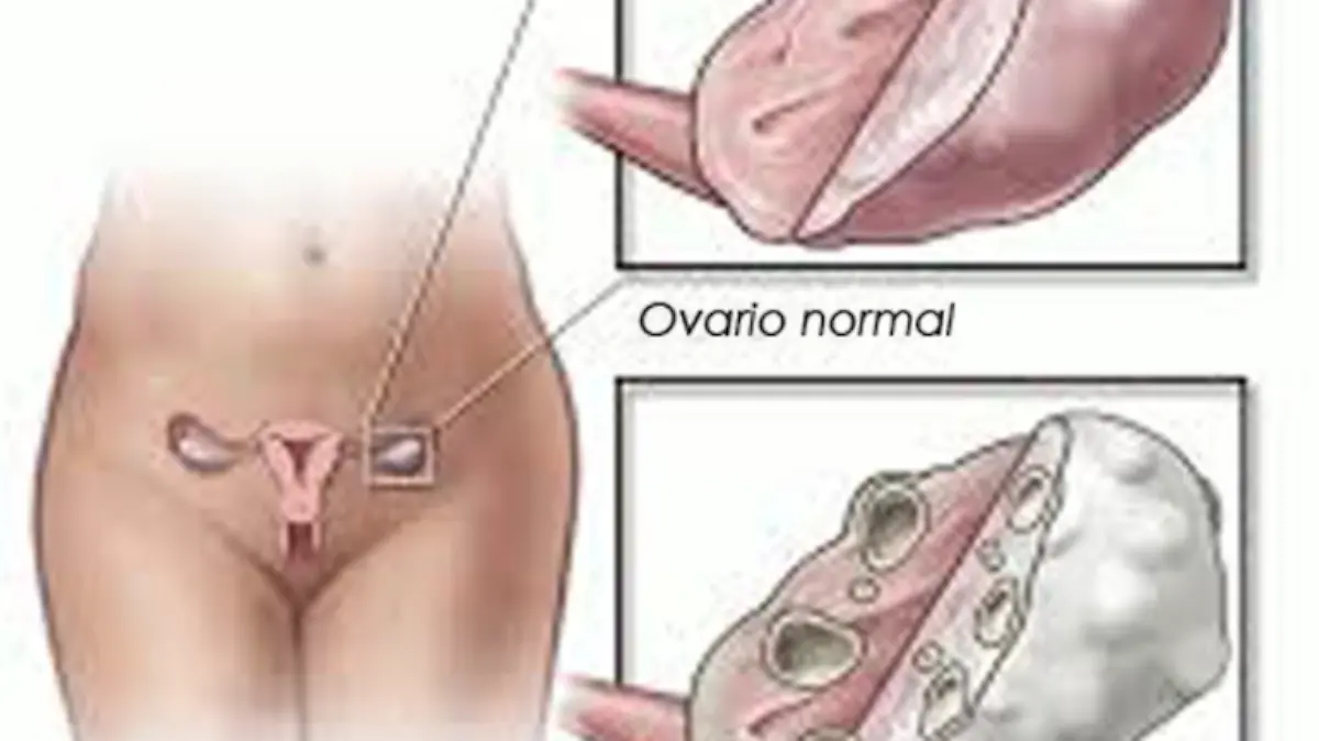 SINDROME DEL OVARIO