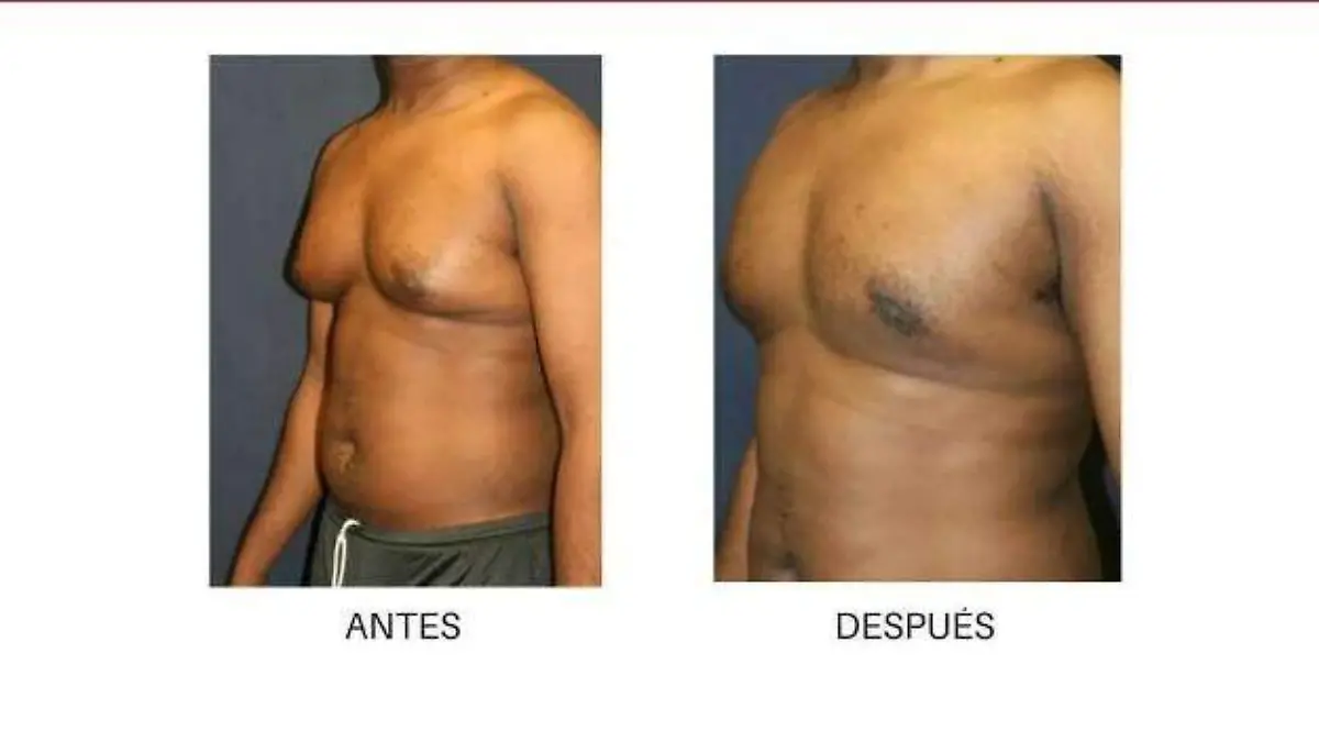Ginecomastia 3