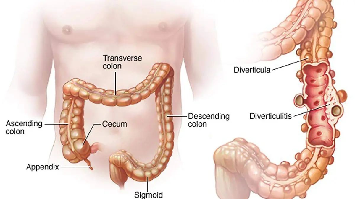 Divertículos son una especie de bolsas a las que se llama 'nidos de golondrina'