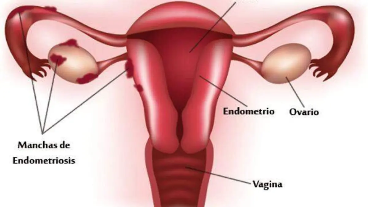 Endometriosis1