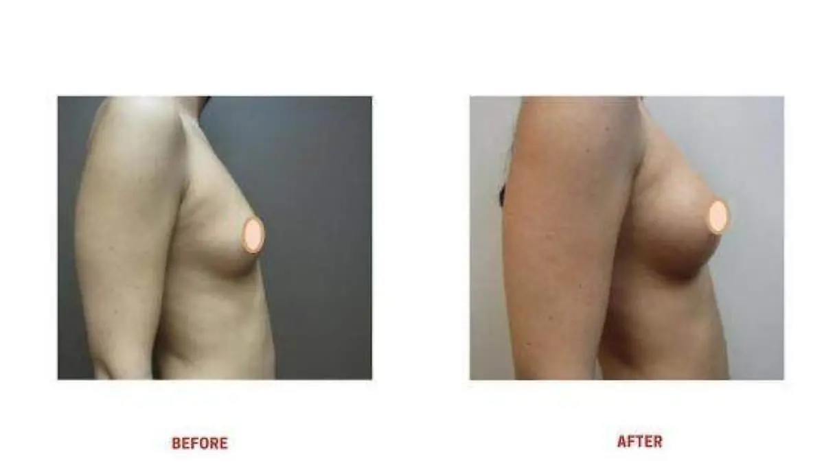 BEFORE AND AFTER LIPOTRANSFERENCIA DE BUSTO 2 W