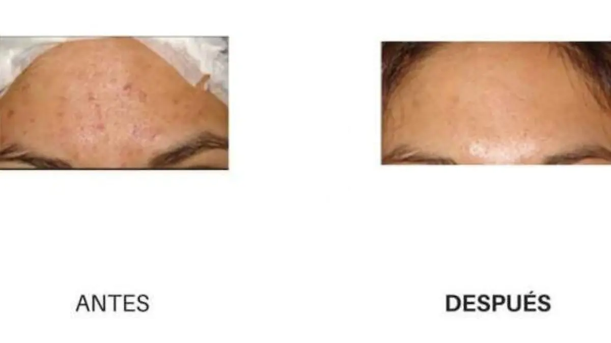 acsp3