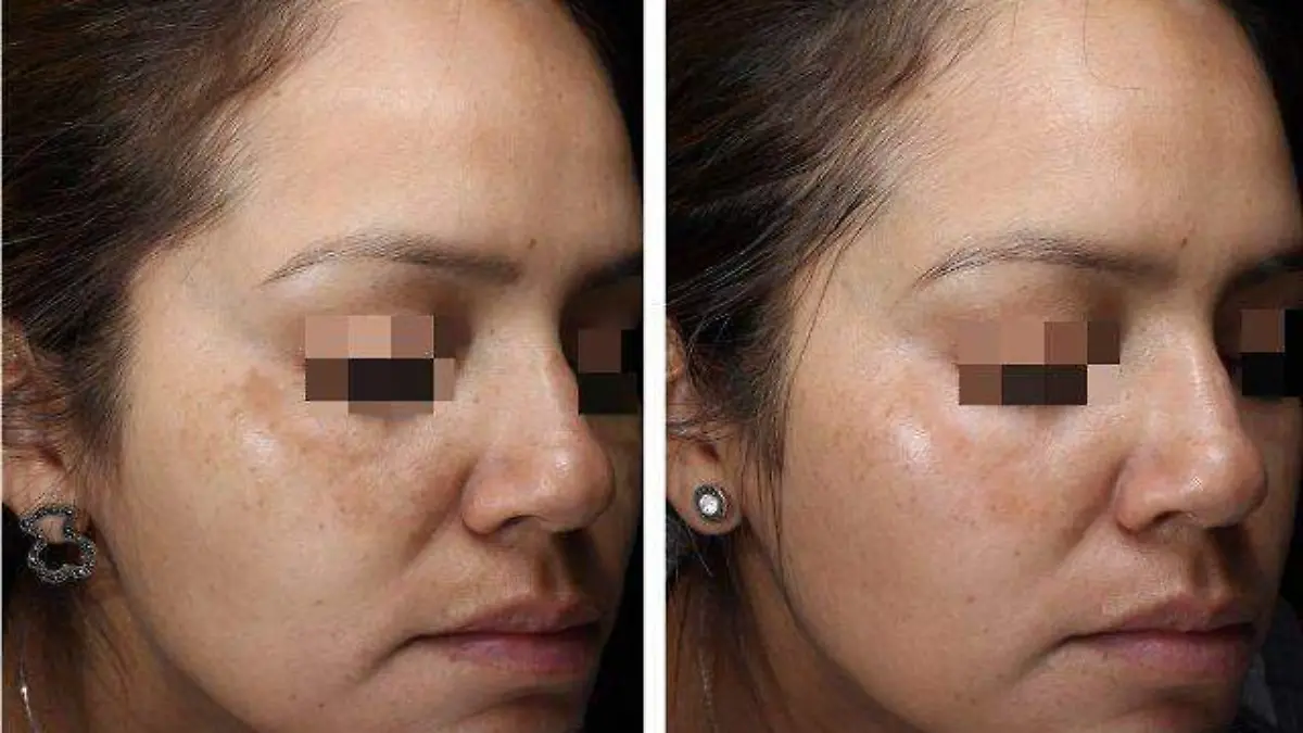 RESURFX_FACIL ENZIMATICO_manchas_melasma