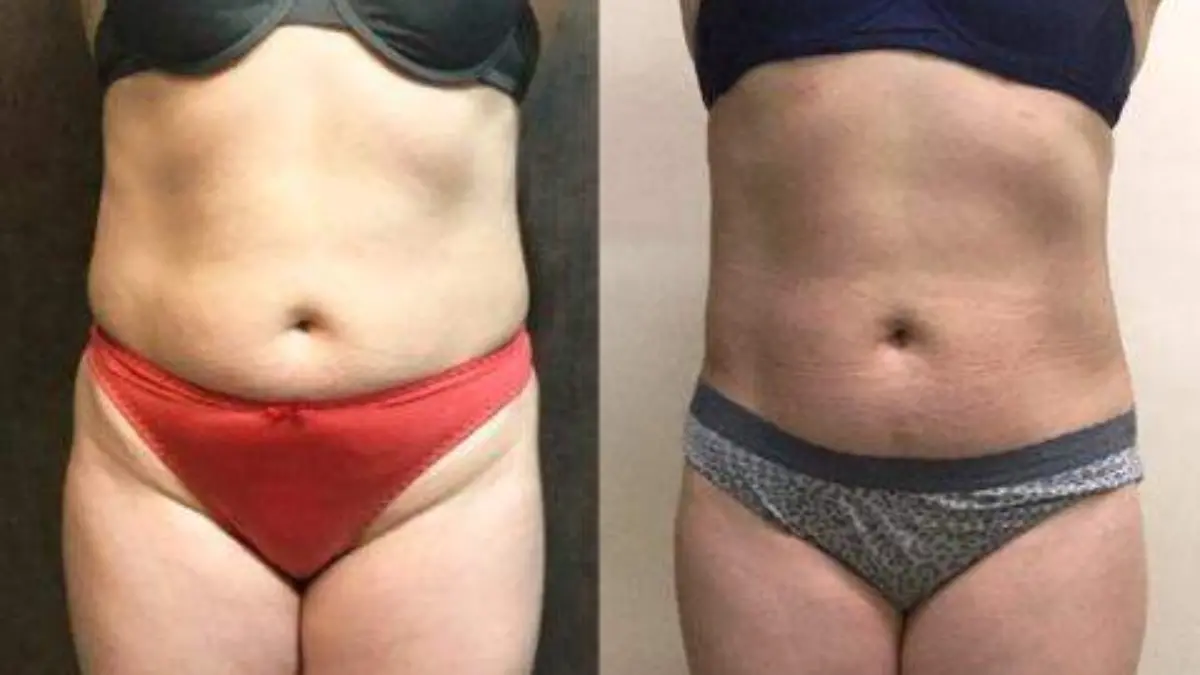 Hidrolipoclasia 5