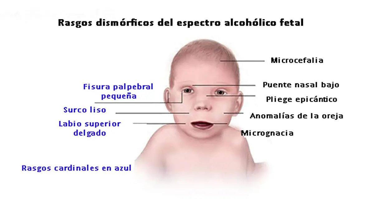 Efectos del  síndrome alcohólico fetal en niños.