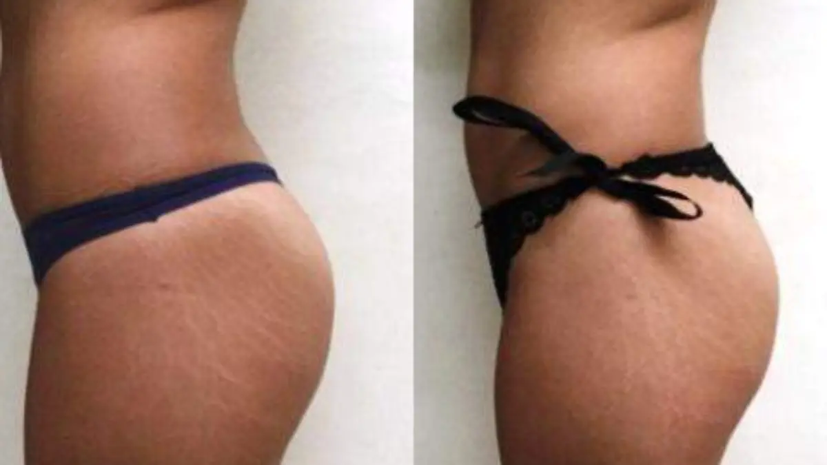 carbossi-estrias-4876