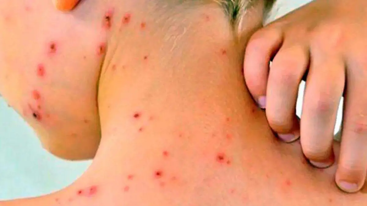 sarampión, niño con sarampión