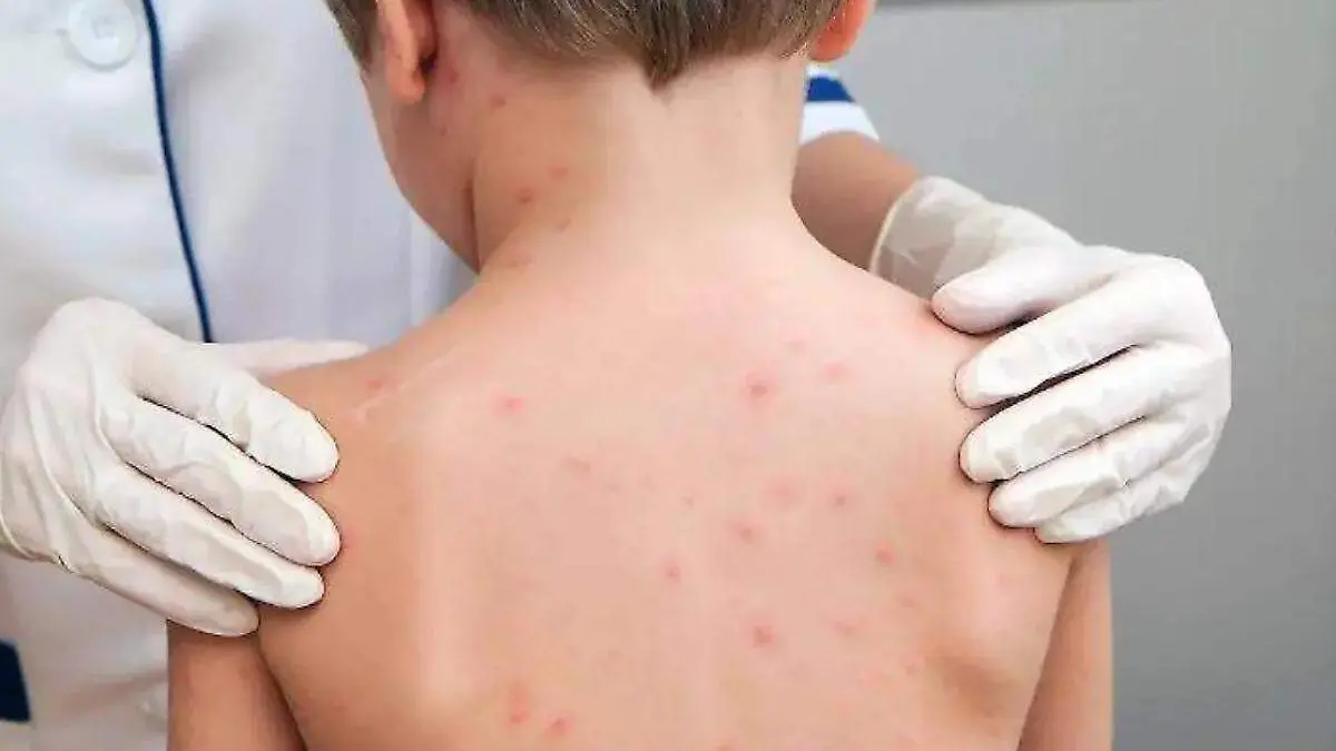 niño con infeccion de sarampion