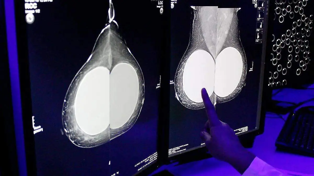 Un ensayo clínico sugiere que el uso de IA en mamografías podría convertirse en una herramienta clave para detectar cáncer de mama de forma más oportuna.