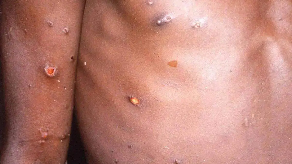 viruela Mpox