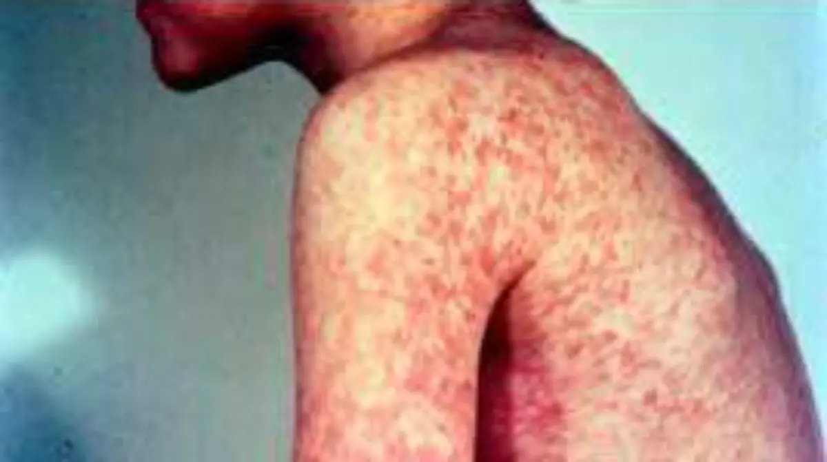  sarampión-Salamanca (1)