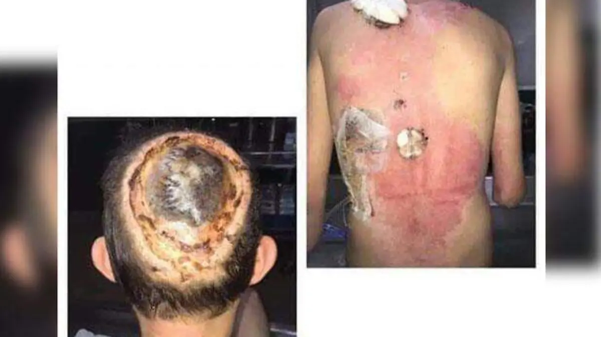 Donativo para electrocutado