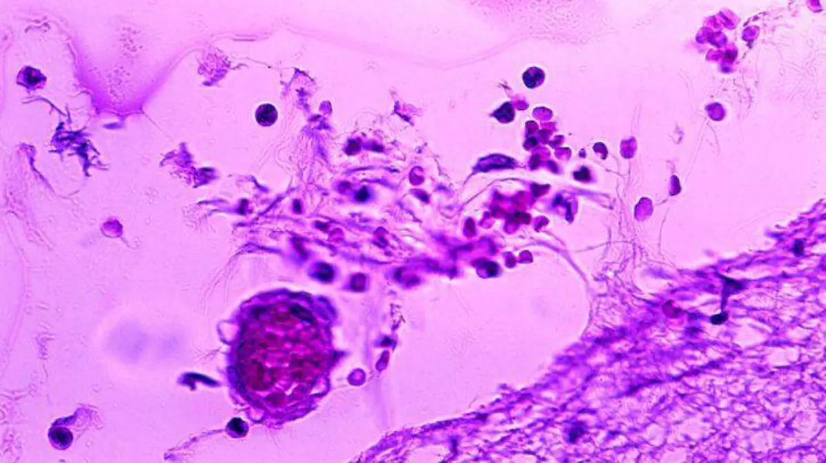 mild-meningitis-with-hemorrhage-due-to-bacillus-anthracis-725x493