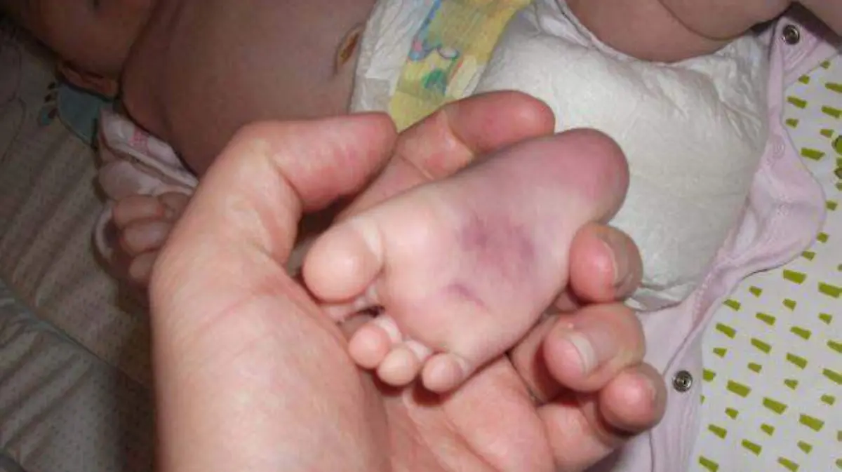 Hemofilia
