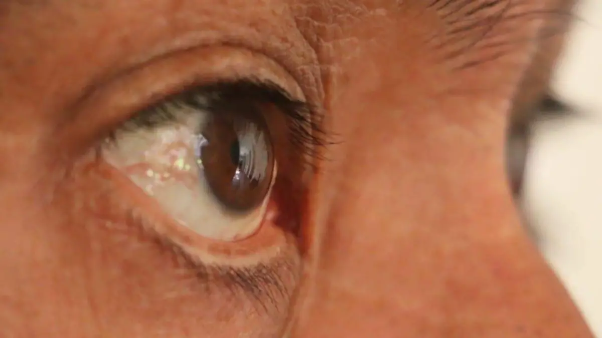 Hepatitis