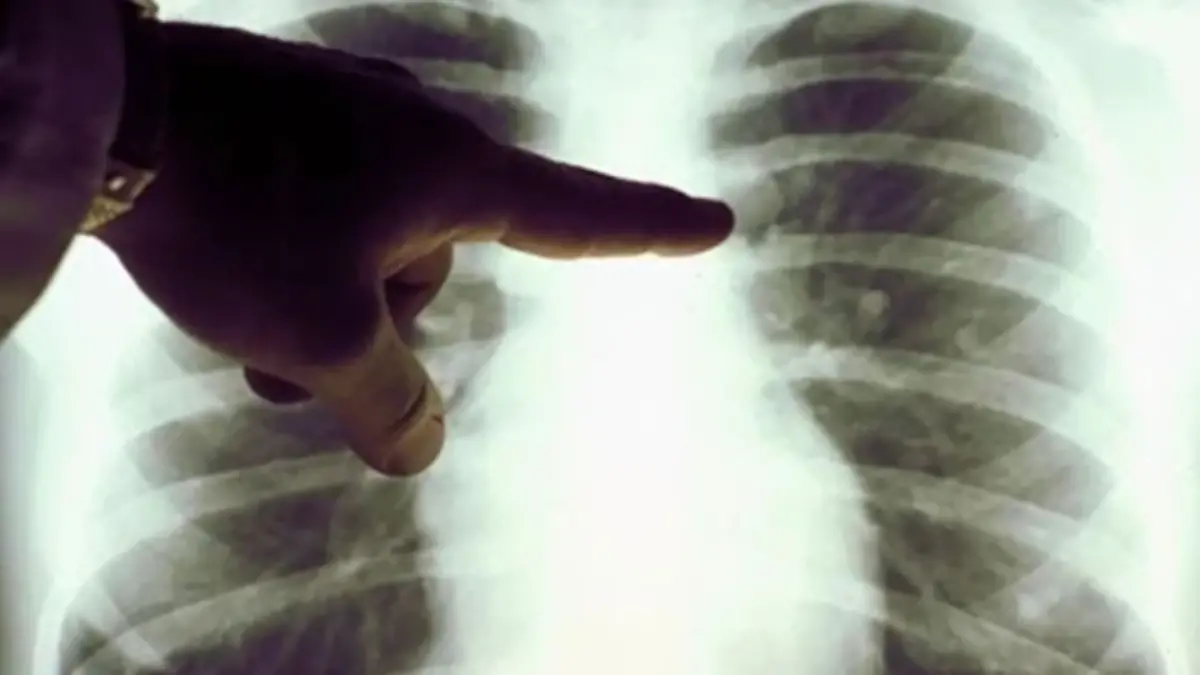 Pulmones IMSS Salud