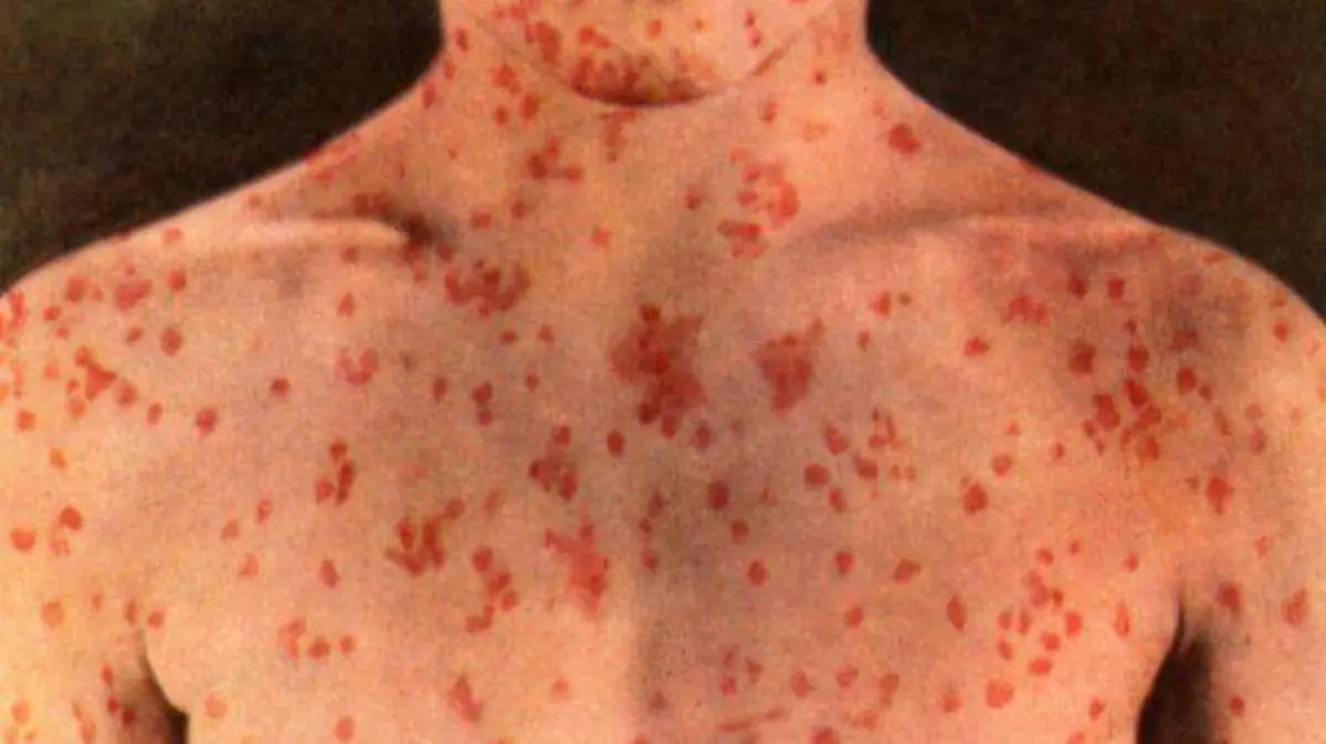 brote-sarampion-mexico-epidemia