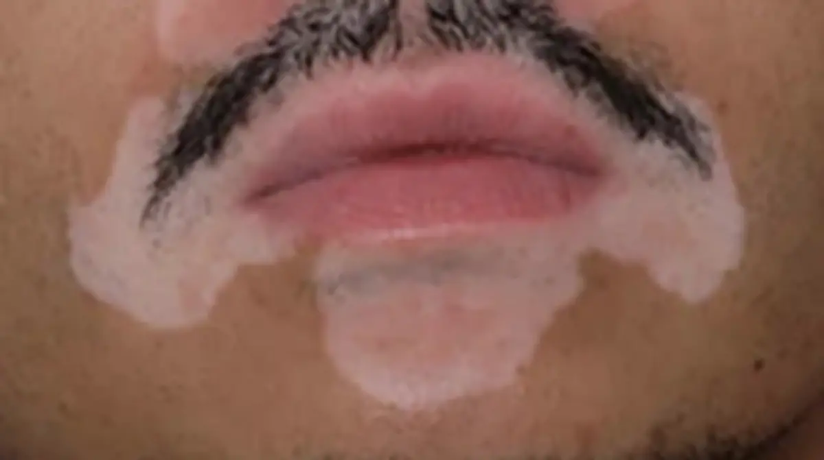 Vitíligo, entre el estigma y el estrés