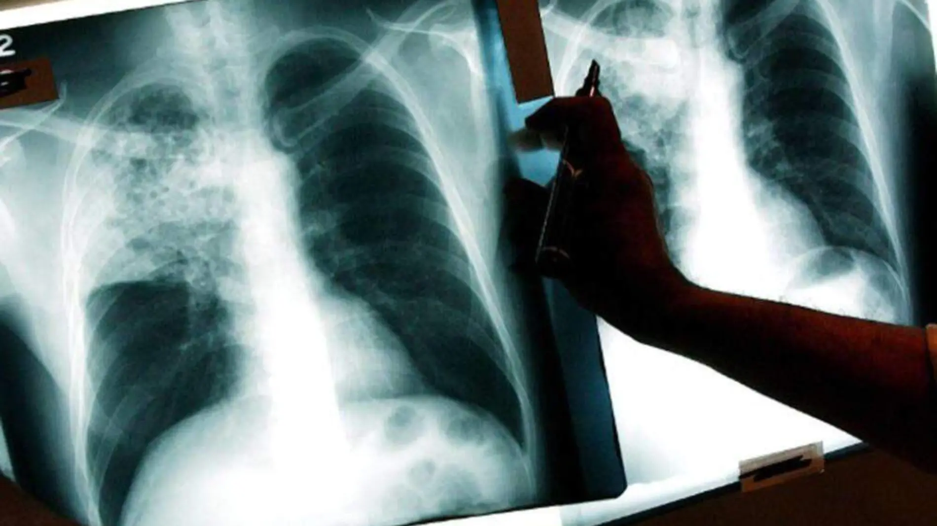 131220023501-tuberculosis-tb-story-top-1000x586