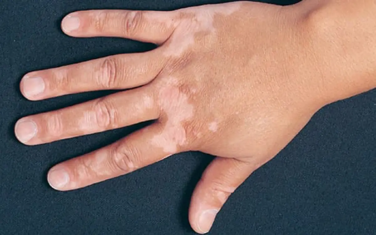 Vitíligo, entre el estigma y el estrés