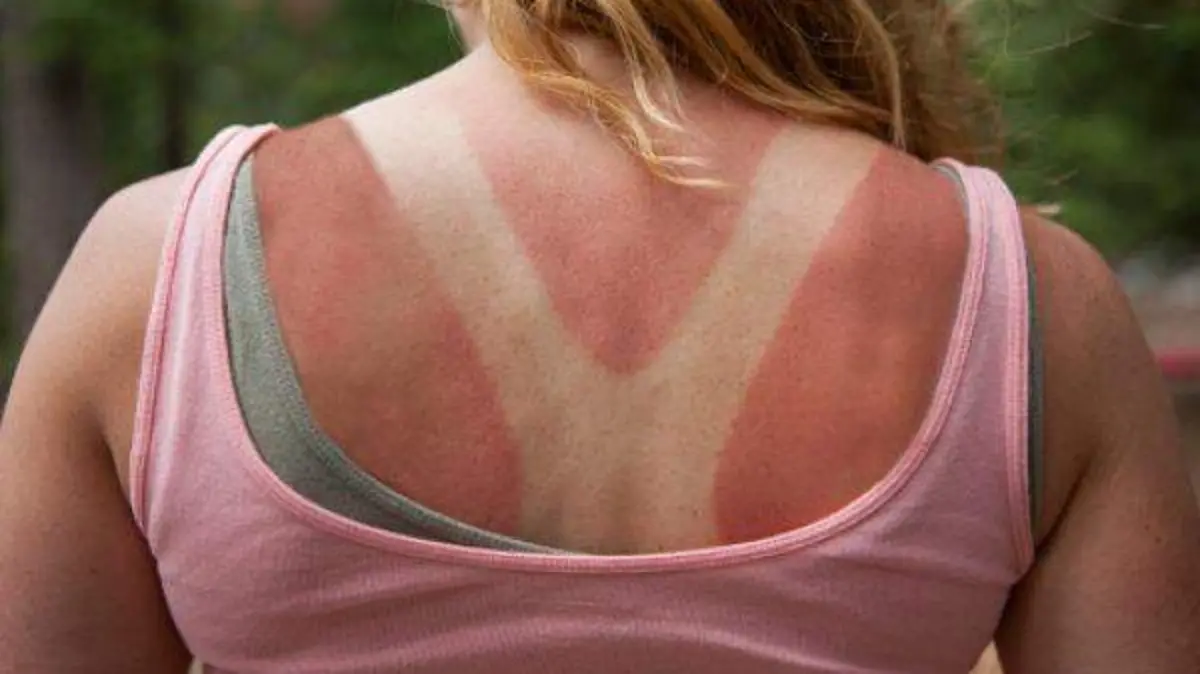 quemadura_del_sol_123