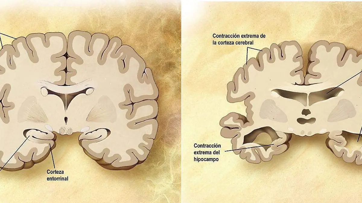 1200px-Cerebro_corte_frontal_Alzheimer