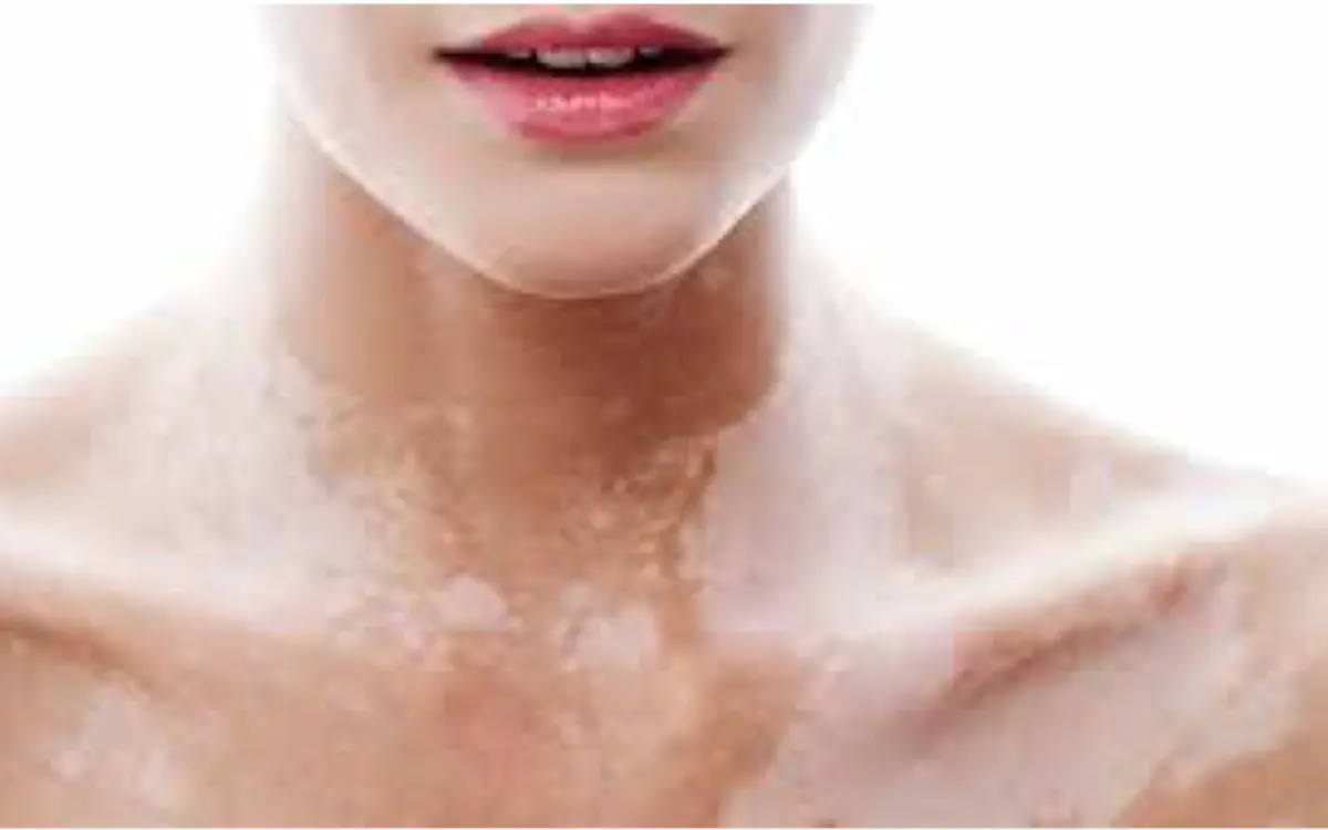 Vitíligo, entre el estigma y el estrés