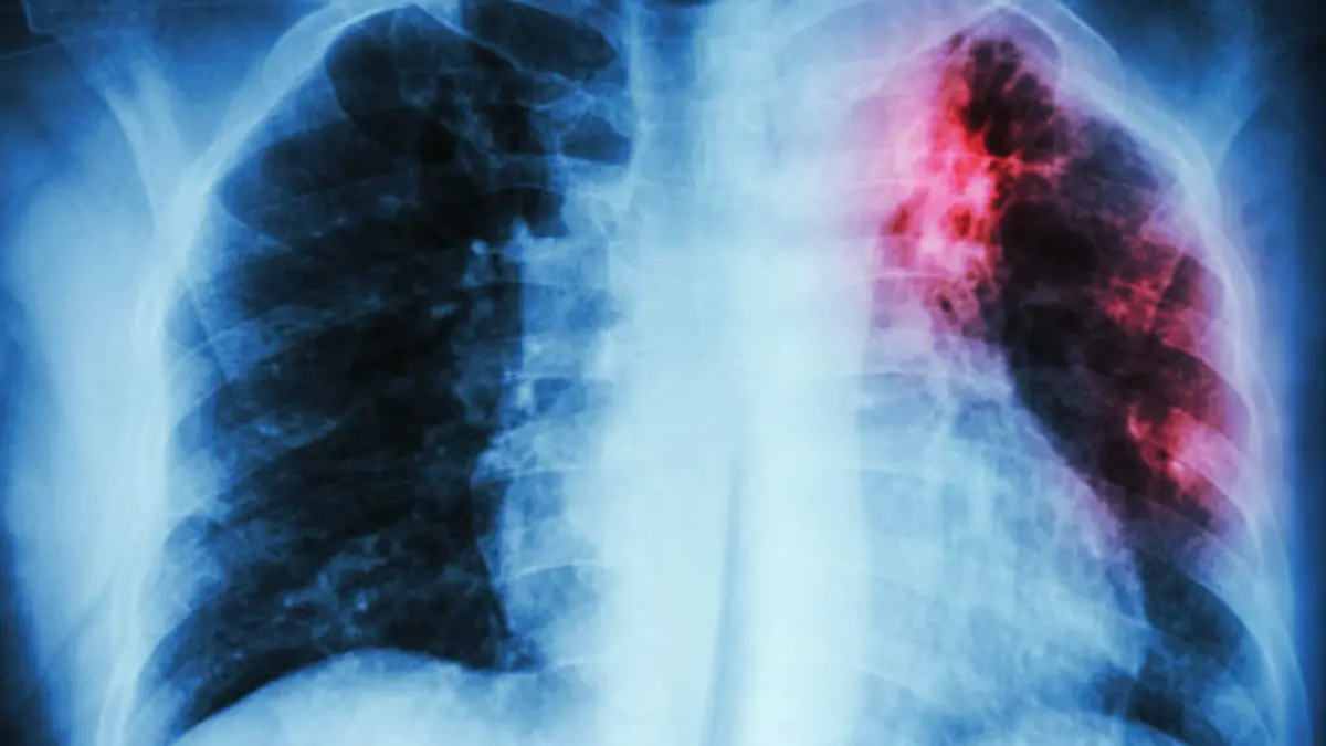 La neumonía inflama los pequeños sacos aéreos de uno o ambos pulmones _ Pexels