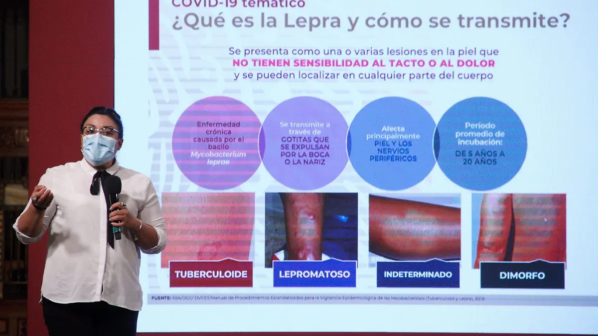 Descartan alerta por lepra en Tamaulipas  